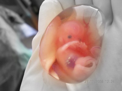 extirpación de útero, a una mujer embarazada de 10 semanas, y enferma de cáncer de cérvix extirpación de útero, a una mujer embarazada, y enferma de cáncer de cérvix.